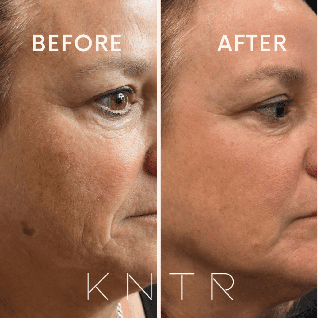 Moxi Laser before and after results showing visible reduction of pigmentation and a lighter appearance of a birthmark on the face.